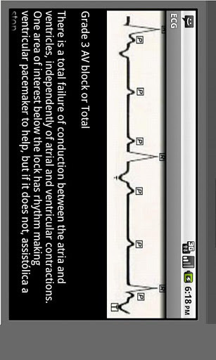 Electrocardiogram ECG Types v6.0