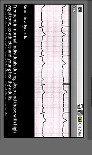 Electrocardiogram ECG Types v6.0