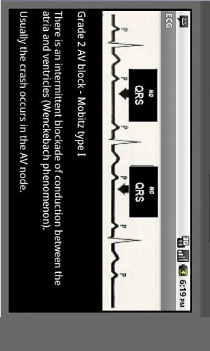 Electrocardiogram ECG Types v6.0